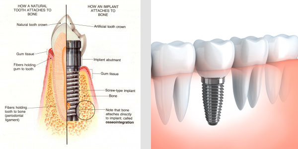 Dental implant